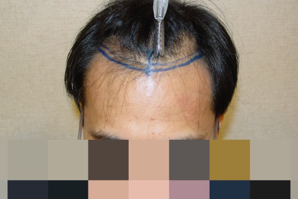 育毛 植毛ブログ 09年06月