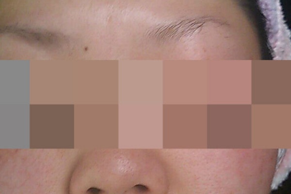 手湿疹 脱ステロイド そして角質培養 画像つき角質培養日記