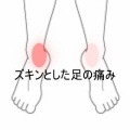 走るとズキンと響く両側後脛骨筋の痛み 　登別室蘭すのさき鍼灸整骨院　症例報告