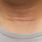 甲状腺がんの手術を受けた人のブログ