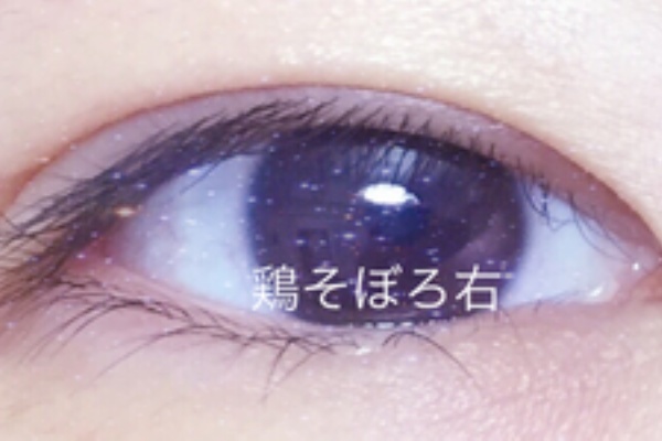 眼瞼下垂経過ブログ 眼瞼下垂ブログ