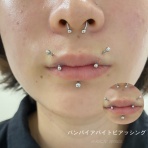 ピアス・ボディピアス穴あけ美容医療