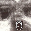 結節様甲状腺腫(甲状腺乳頭癌疑)