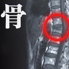 知っていますか？“骨卒中” 高齢者は適度な運動と栄養が大切