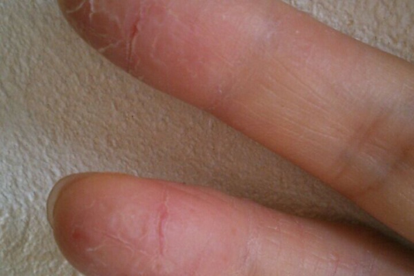 手湿疹 脱ステロイド そして角質培養