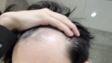 【悲報】ワイ（28）の頭皮、限界突破ｗｗ