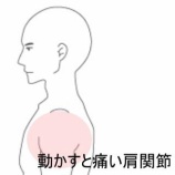 『仕事中の重量物で生じた左肩の鈍痛　登別室蘭すのさき鍼灸整骨院　症例報告』の画像