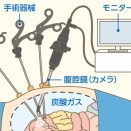 腎盂癌 闘病記【23】手術後編