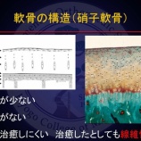 『膝の軟骨疾患』の画像