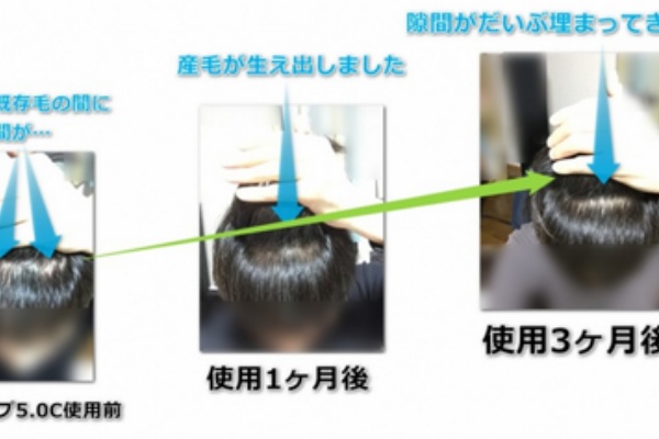 ミノキシジルとキャピキシル育毛剤どっちがm字に効果があるか大検証 キャピキシル