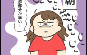 帯状疱疹になりました②