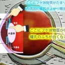 眼球の瞳のふちが白くなる落屑膜症候群　急激な眼圧上昇に注意です