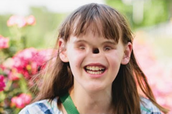 生まれつき目と鼻が無い少女 : アマドリス