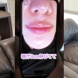 【驚愕】Matt、「顎が3cm伸びた」！ヒアルロン酸で顔面変化した写真公開が話題に