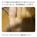 【悲報】人気配信者「カップ焼きそばのお湯、足にこぼした…」→とんでもない火傷にｗｗｗｗｗ