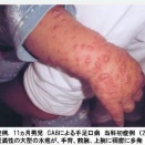 手足口病　Summary