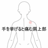 『テニスによる急性の右肩・背中の痛み 登別室蘭すのさき鍼灸整骨院 症例報告』の画像