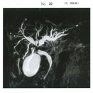 119D59　肝門部胆管癌