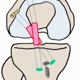 『前十字靭帯再建術後のリハビリテーション』の画像