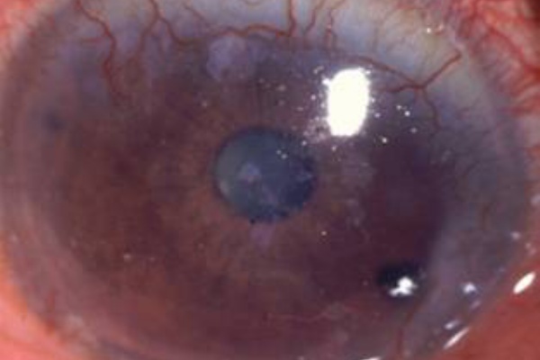 コンタクトの限界 コンタクトレンズつけっぱなしはng 非常に危険