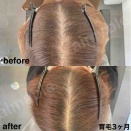 育毛ビフォーアフター
