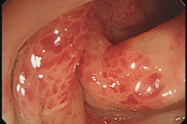 下腹部痛に続く下血 虚血性腸炎 とよない院長ブログ