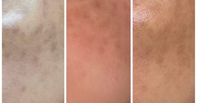 QスイッチYAGレーザー「シミ取り放題」2か月経過レポ｜50代主婦のリアルな色素沈着の変化