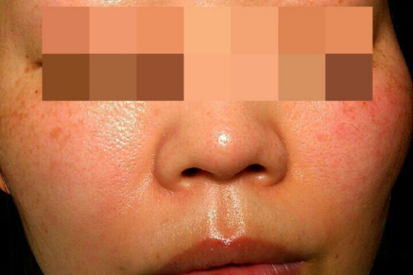 手湿疹 脱ステロイド そして角質培養 画像つき角質培養日記