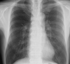 マイコプラズマ肺炎(60代)