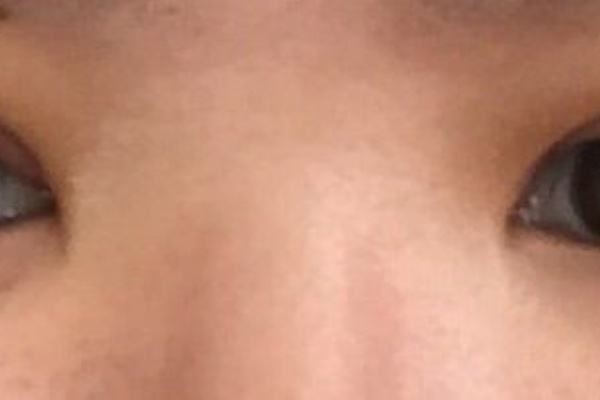 全切開 眼瞼下垂 経過ブログ