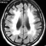 『血圧管理の厳格化が脳血管性認知症を減らしている』の画像