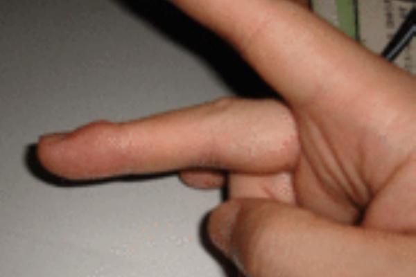 試験が終わり そしてペンだこが残った 米谷の 知恵の館 Blog校