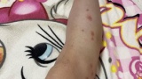 【閲覧注意】毎日変な虫に刺されてる（※画像あり）