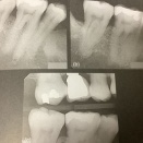 根管形成　その1