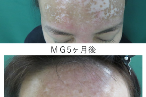 白斑 乾癬サポートブログ 19