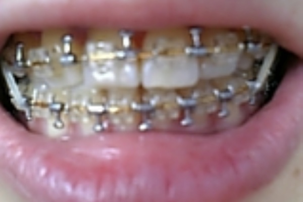 大人の歯列矯正 手術アリ 術前矯正