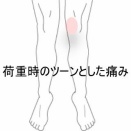 荷重時に起こる膝内側の鋭い痛み　登別室蘭すのさき鍼灸整骨院　症例報告