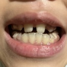 小6娘　受け口矯正終了