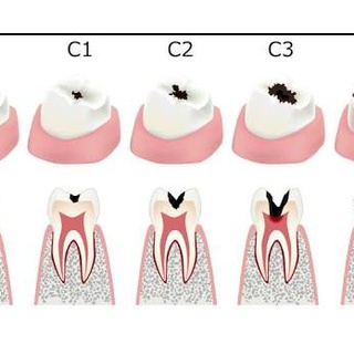 『【知ってた】虫歯は怖いんやで…』の画像