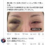 【悲報】女さん　整形手術で片目を失明😢