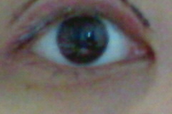 玲那の眼瞼下垂手術経過 10