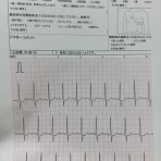 発作性心房細動根治を目指して♪