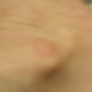 低温火傷😢
