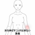 左肘が伸ばせず重だるいテニス肘様症状　登別室蘭すのさき鍼灸整骨院　症例報告