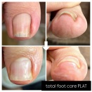 巻き爪補正症例