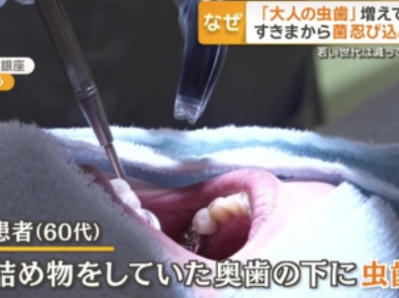 【警告】歯医者『過去に治療した虫歯の再発、急増』