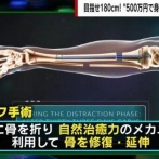 ガジェット系YouTuber、骨延長手術を受け身長を約7センチ伸ばした事を報告  掛かった費用は⋯