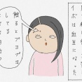 皮膚科で老人性イボ(脂漏性角化症)をとってもらう・後編