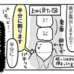 親知らずを抜こうと思っただけなのに⑥【歯茎を切って、歯を割る。】