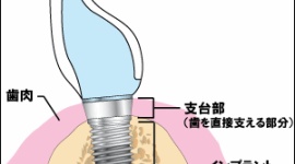 【医療】トラブル絶えない歯科インプラント　患者が減り、このままでは日本から消える？